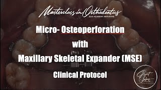 MicroOsteoperforation with Maxillary Skeletal Expander  MSE  Jaw Expansion  Clinical Protocol [upl. by Pussej]