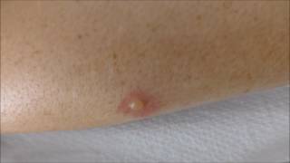 blisters from mosquito bites  before and after treatment [upl. by Rizzi]