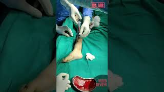 Aneurysmal Bone Cyst ABC Distal Tibia bone  Treatment l Dr Alok Aggarwal Delhi l 8 years Child [upl. by Gertrud822]