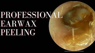 Professional Earwax Peeling [upl. by Niatirb]