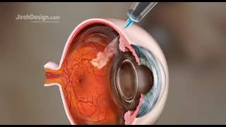 Intravitreal Injection Animation HD [upl. by Weed]