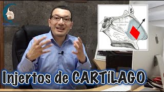 INJERTOS de CARTÍLAGO en Rinoplastía 👃🏻👂🏻🦴 ¿Cómo los obtenemos  PlasticFacial MX [upl. by Weatherby]