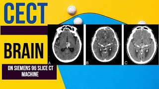 🧠HOW TO DO CECT BRAIN  CONTRAST CT BRAINHEAD SIEMENS 96 SLICE CT MACHINE 📊 [upl. by Imoyik978]