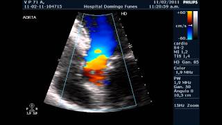 Insuficiencia Valvular Aortica Aorta Bicuspidewmv [upl. by Lewie]