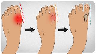 How to Fix Bunions in 5 Steps [upl. by Sitnalta]