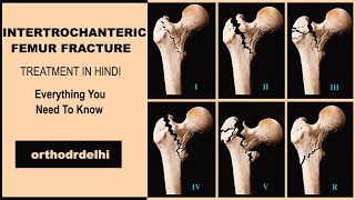 INTERTROCHANTRIC FRACTURE FEMUR IN HINDI proximal femur fractures IN HINDI [upl. by Senhauser921]