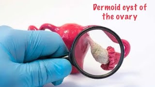 What is dermoid cyst  ovarian cyst   Dr JANANI [upl. by Seaddon]