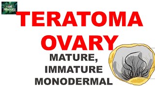 TERATOMAOVARY Ovarian Tumor Series Part 5 [upl. by Idnyc661]