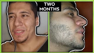 FAST Minoxidil Beard Transformation  SHOCKING  LanDope [upl. by Nawek613]