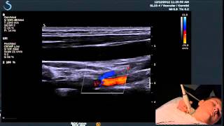 Hot Tips  Finding the Vertebral Artery with Ultrasound [upl. by Merc]