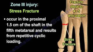 Proximal Fifth Metatarsal Fractures  Everything You Need To Know  Dr Nabil Ebraheim [upl. by Andriette630]