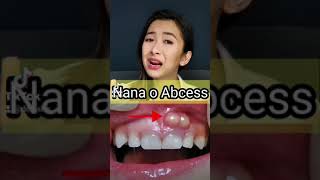 Bukol sa gilagid Nana o abcess na yan youtubeshorts shorts [upl. by Marilla]