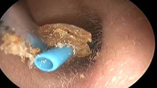 Ablation drain doreille ATT aérateur eartube JB Danvin [upl. by Aderb819]