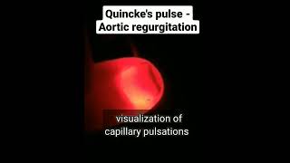 Quinckes pulse  Aortic regurgitation [upl. by Casar]