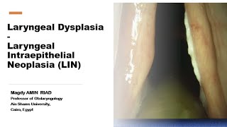 Laryngeal Intraepithelial NeoplasiaLIN Laryngeal Dysplasia [upl. by Nelyaw]