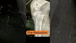 Close reduction of proximal epiphyseal slip of tibia in kids  SALTERHARRIS type 1 [upl. by Yebot]