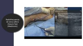 RADIOFRECUENCIA ENDOVASCULAR Closure Fast [upl. by Macdonell]