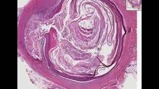 Histopathology SkinEpidermal inclusion cyst [upl. by Mages]