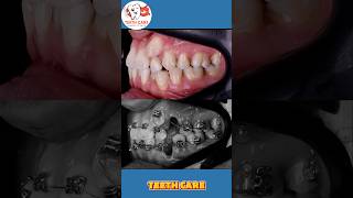 braces transformation teeth braces dental dentalcare dentalhealth dentalimplants shorts [upl. by Tobin]