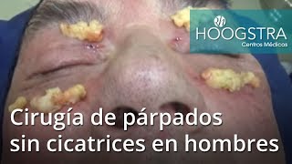 Cirugía de párpados sin cicatrices en hombres 18212 [upl. by Novihc]