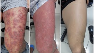 Dealing with Itching of Psoriasis [upl. by Bbor948]