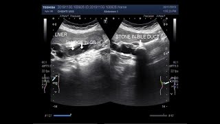 Ultrasound Video showing a large stone in Bile duct called Choledocholithiasis [upl. by Coughlin]