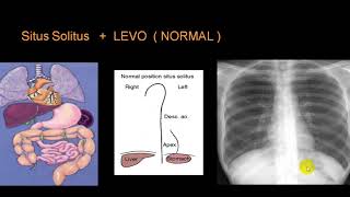 DEXTROCARDIA [upl. by Percy]