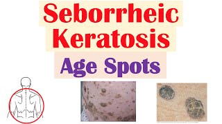 Seborrheic Keratosis “Age Spots”  Risk Factors Causes Skin Lesions Diagnosis Treatment [upl. by Ssitnerp]