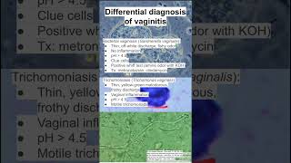 Differential diagnosis of vaginitis [upl. by Hilliary]