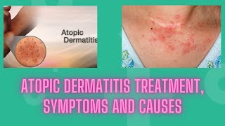 Atopic dermatitis treatment symptoms and causes  Nuse Healthy [upl. by Atinauj]