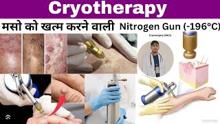 Cryotherapy Treatment Of Skin cryotherapy wartsnitrogengundermambbsdermatology skinproblems [upl. by Ycat]