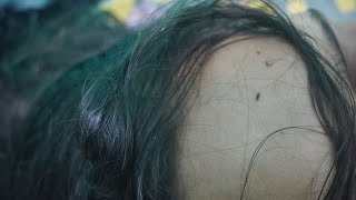 Nits and Lice Popping Sounds with Hand  Lice Infested [upl. by Cassella]