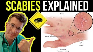 Doctor explains SCABIES skin rash including SYMPTOMS PHOTOS OF SKIN TREATMENT amp more [upl. by Jemimah]