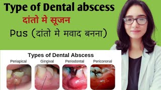 Dental abscess दांतो मे सूजन Tooth Pus Abscess type and treatment mouth swelling treatment [upl. by Broek]