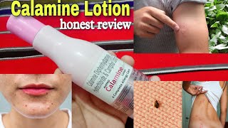 Calamine Lotion Benefits amp Uses  Dephenhydramide HCL Camphor  Austro Calamine Lotion [upl. by Koa]