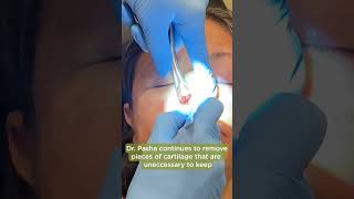 REMOVING THE NASAL CARTILAGE  Balloon Septoplasty Part 5 [upl. by Enrol186]