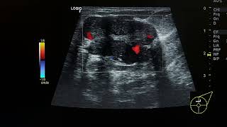 fibroadenoma ultrasound case [upl. by Suivatnad]