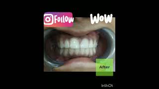 Direct composite veneers for gaps between teethDr Jhalak Gandhi [upl. by Sanbo]