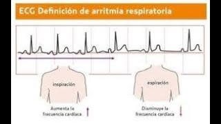 Arritmia sinusal respiratoria [upl. by Elden708]