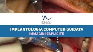 Chirurgia Orale Implantologia computer guidata  Stdio Dentistico Valenti [upl. by Kristie]