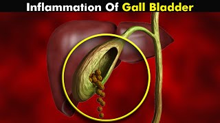 Cholecystitis Gallbladder Inflammation  Symptoms Causes and Treatment UrduHindi [upl. by Jakoba]