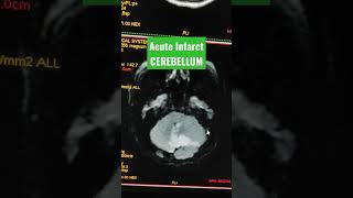 Large Acute Infarct in Cerebellum viral youtubeshorts mri [upl. by Selij]