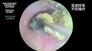 Cleaning of mold and fungi in tortuous ear canal with dry slices [upl. by Attenhoj243]