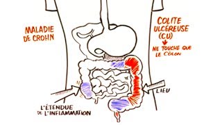 Maladie Inflammatoire de Lintestin MII [upl. by Osei]