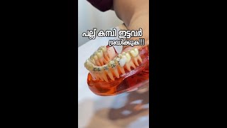 പല്ല് കമ്പി ഇട്ടവർ ശ്രദ്ധിക്കുക dentalbraces aftercare dentalexperience [upl. by Yedrahs]