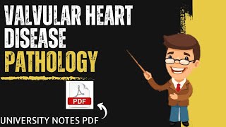 Valvular Heart Disease  CVS  Systemic Pathology  Pathology MBBS [upl. by Nylyrehc]