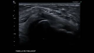 Nerve ultrasound case  fibular peroneal nerve entrapment and a fabella [upl. by Amaras665]