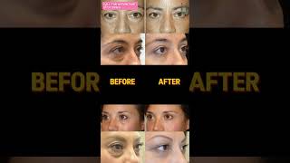 Hollow Eye Correction by Dermal Filler [upl. by Saffier316]