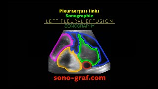 Sonographie  Pleuraerguss links [upl. by Daas]