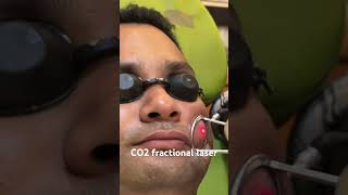 CO2 fractional laser co2 bollywood music laser treatment shorts dransharma hairregeneration [upl. by Nnawtna846]